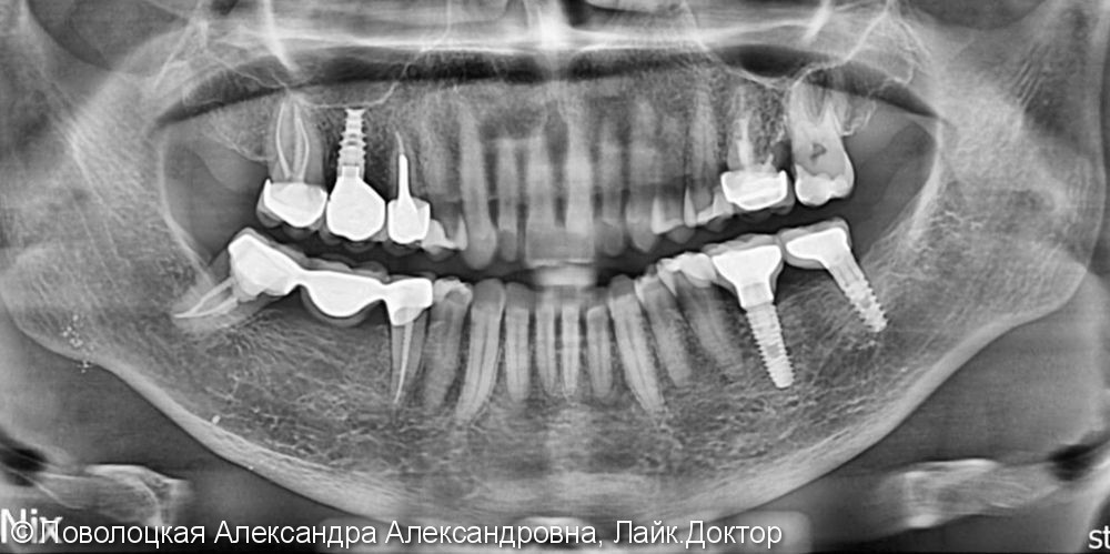 3D костная пластика и дентальная имплантация 36 зуба - фото №4