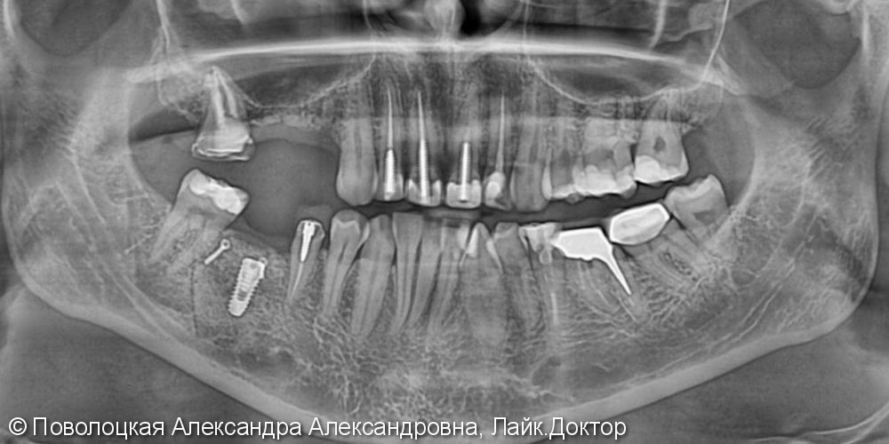 3D костная пластика дентальная имплантация 46 зуб - фото №1