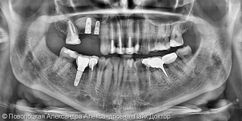 3D костная пластика дентальная имплантация 46 зуб - фото №2