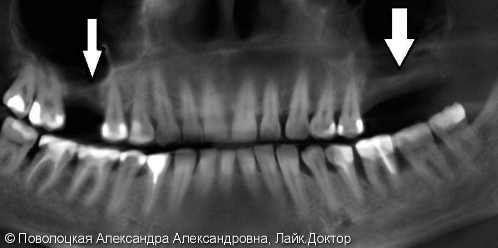 Открытый синус-лифтинг дентальная имплантация 16 26 27 зубов Nobel Parallel - фото №2