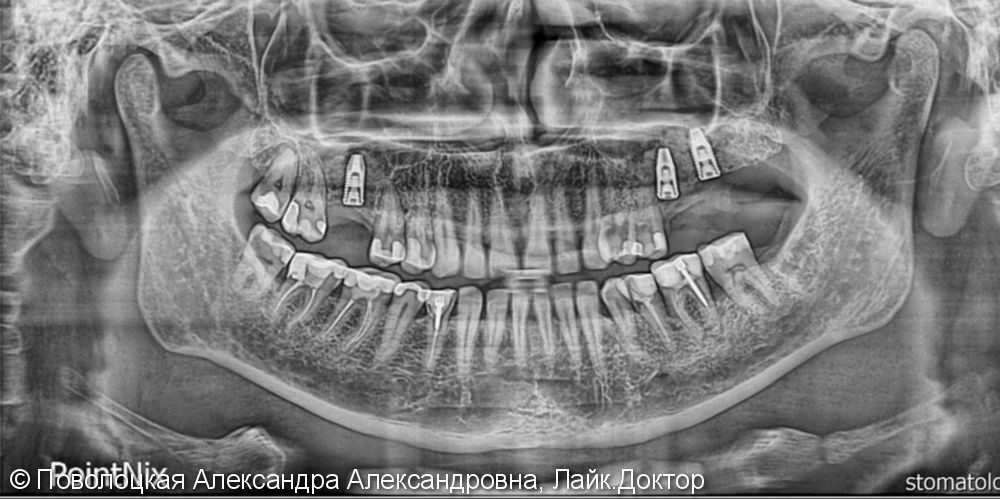 Открытый синус-лифтинг дентальная имплантация 16 26 27 зубов Nobel Parallel - фото №3