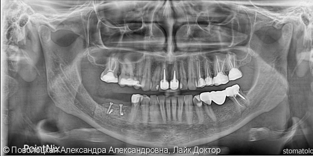 Костная пластика на нижней челюсти справа и слева по Ф.Кури, дентальная имплантация Osstem  в позиции 46 47 36 37 - фото №1
