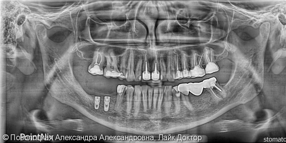 Костная пластика на нижней челюсти справа и слева по Ф.Кури, дентальная имплантация Osstem  в позиции 46 47 36 37 - фото №2