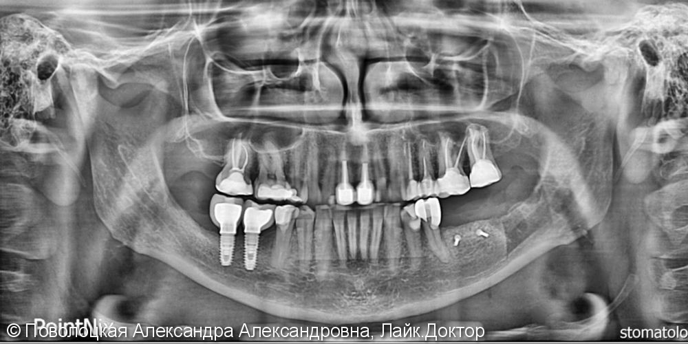 Костная пластика на нижней челюсти справа и слева по Ф.Кури, дентальная имплантация Osstem  в позиции 46 47 36 37 - фото №3