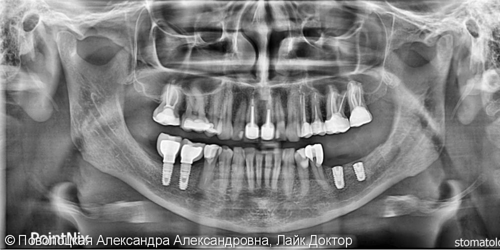 Костная пластика на нижней челюсти справа и слева по Ф.Кури, дентальная имплантация Osstem  в позиции 46 47 36 37 - фото №4