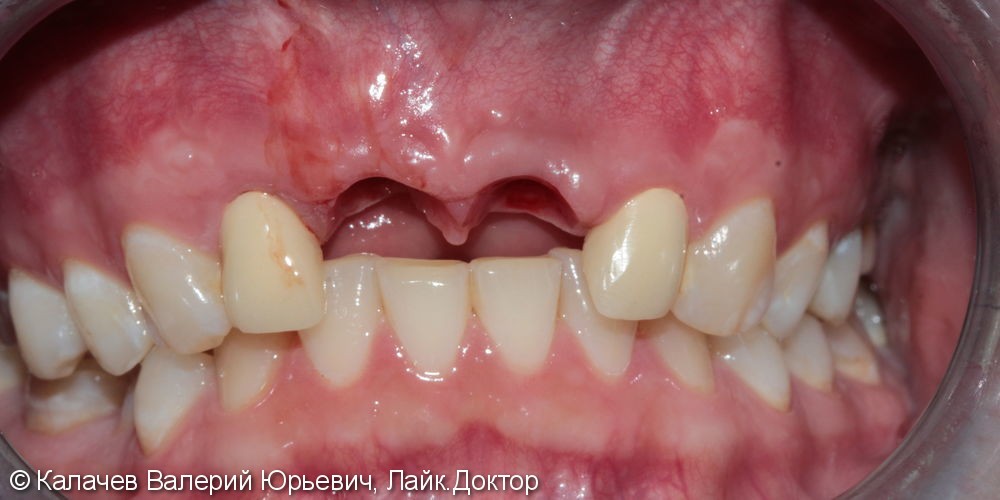 Протезирование двух передних зубов на имплантах - фото №1