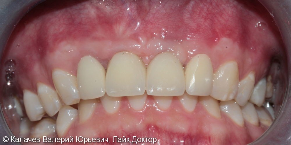 Протезирование двух передних зубов на имплантах - фото №2