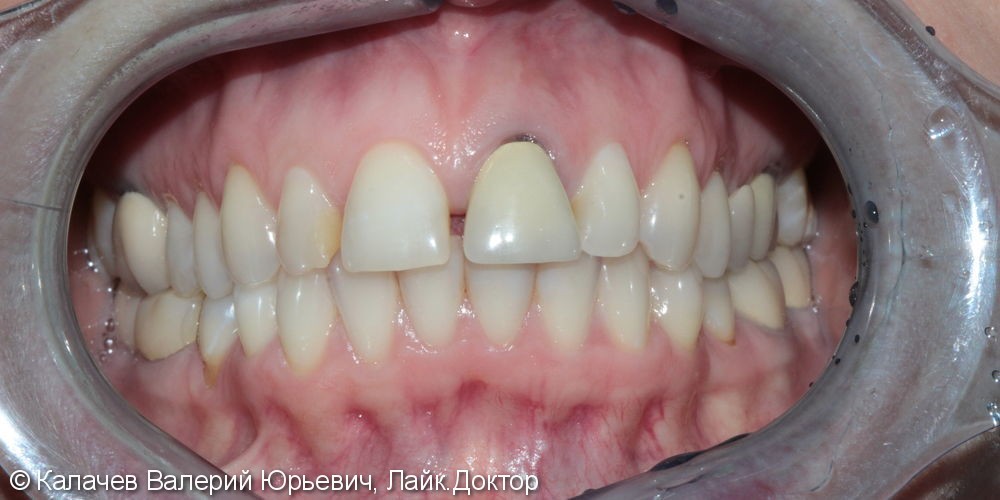 4 винира E-max на верхние зубы, до и после - фото №1