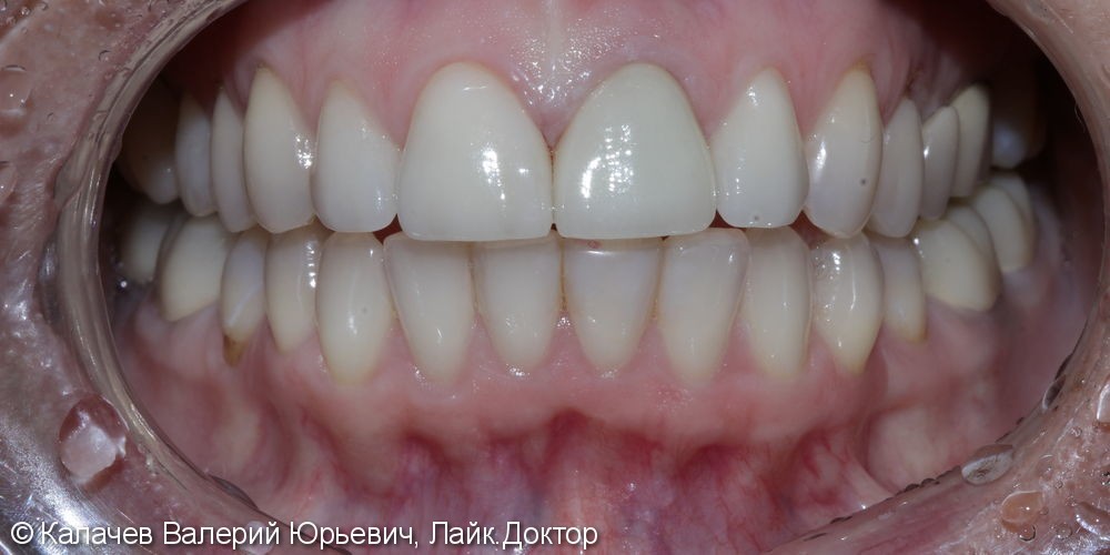 4 винира E-max на верхние зубы, до и после - фото №2