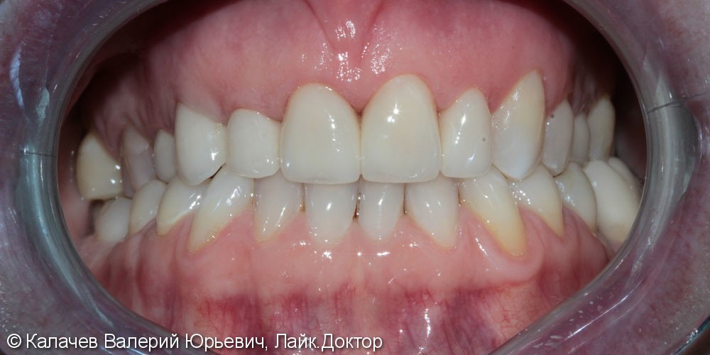 Ортопедическая реставрация, безметалловые коронки на передние верхние зубы - фото №2