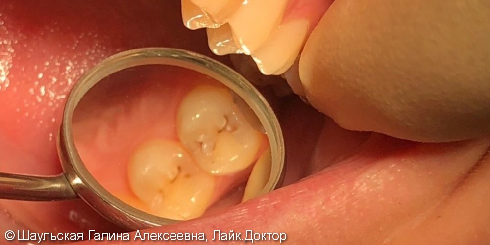 Восстановление анатомической формы двух зубов материалом Esthet X - фото №1
