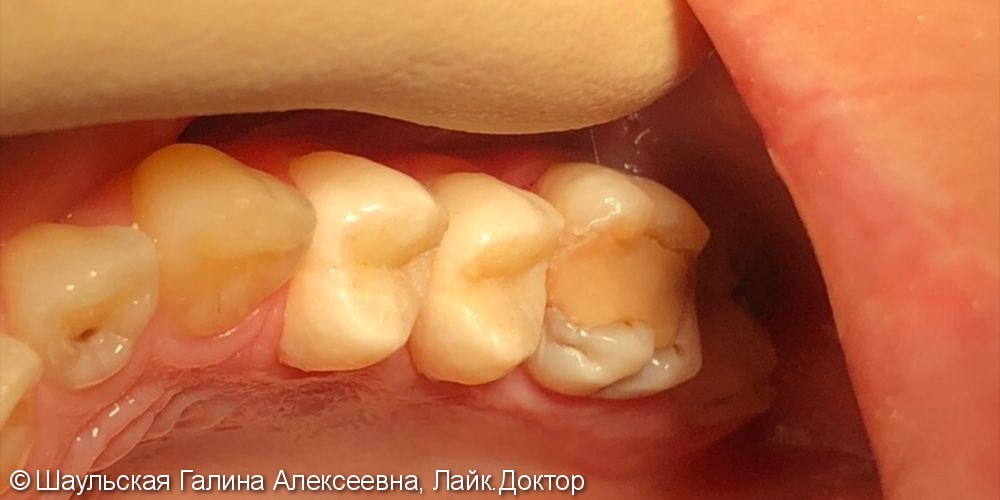Восстановление анатомической формы двух зубов материалом Esthet X - фото №4