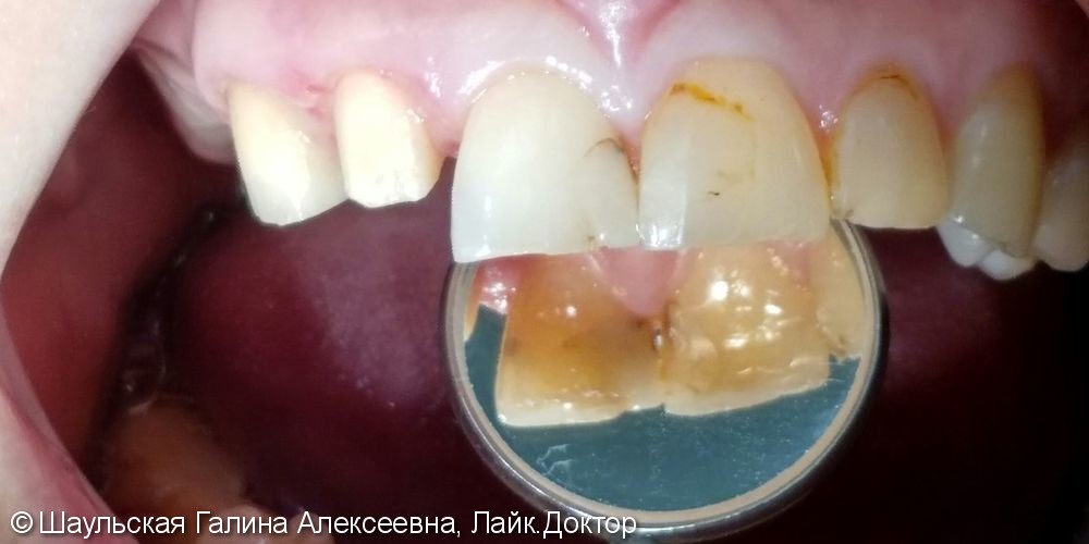Комплексное лечение 21 и 11 зубов, до и после - фото №1