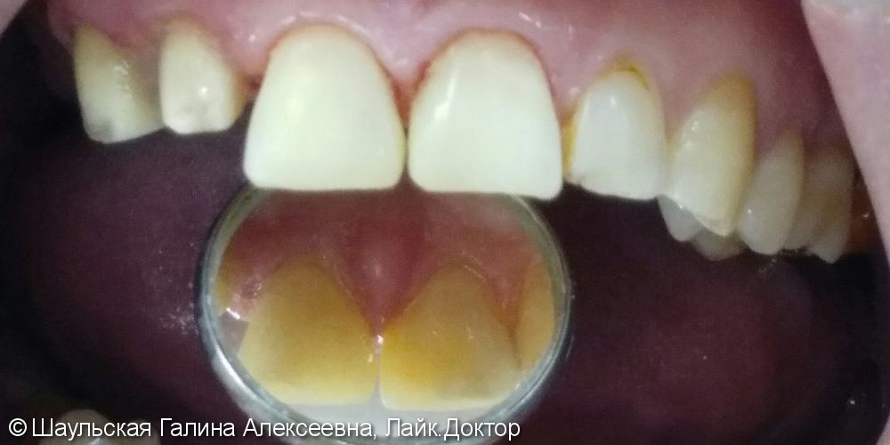 Комплексное лечение 21 и 11 зубов, до и после - фото №2