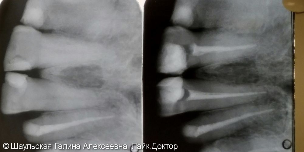 Комплексное лечение 21 и 11 зубов, до и после - фото №3