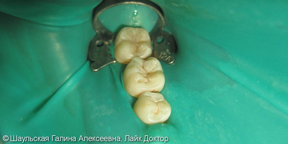 Лечение кариеса трех соседних зубов за одно посещение - фото №3