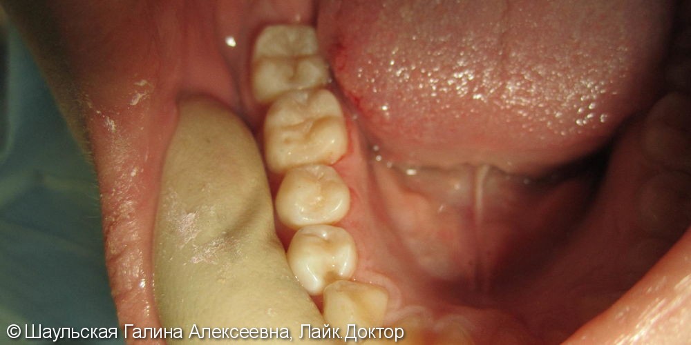 Лечение кариеса трех соседних зубов за одно посещение - фото №5