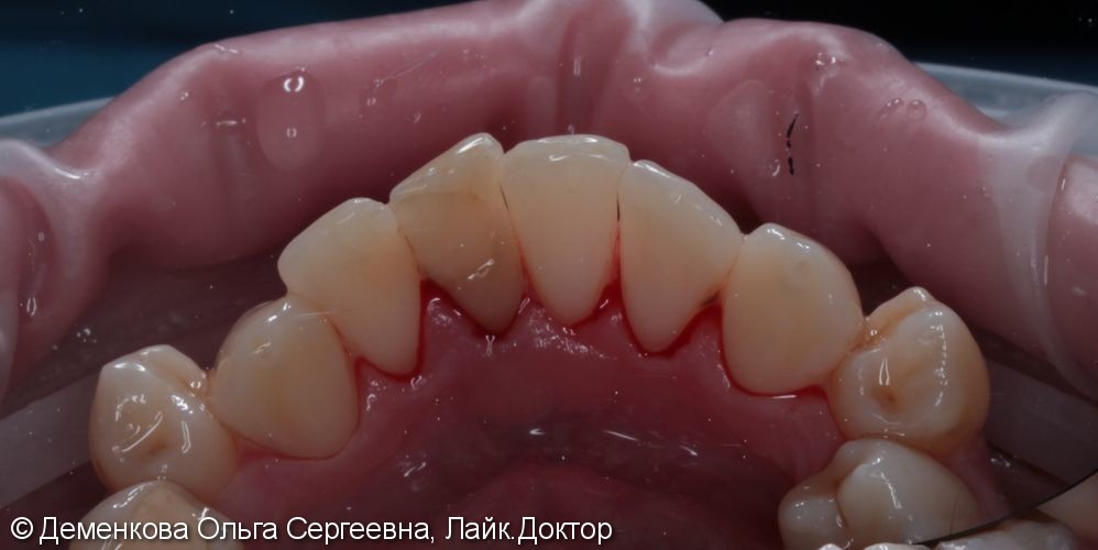 Чистка зубов - фото №3