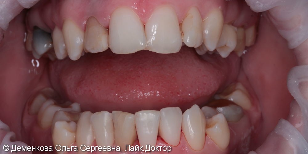Чистка зубов - фото №4