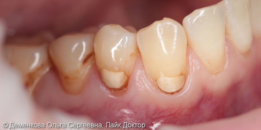 лечение зубов и восстановление их реставрационным пломбировочным материалом - фото №1
