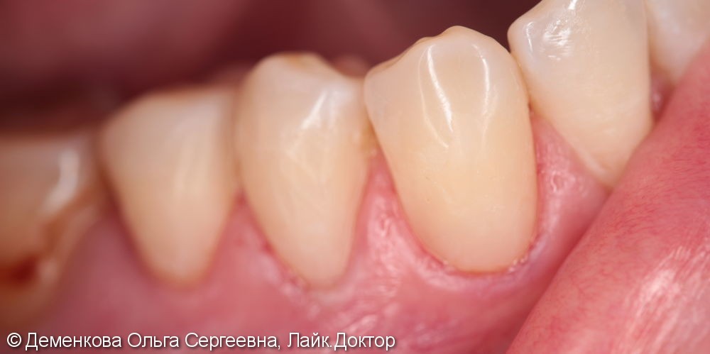 лечение зубов и восстановление их реставрационным пломбировочным материалом - фото №2