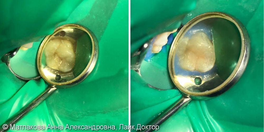 Лечение фиссурного кариеса в зубе 17 - фото №1