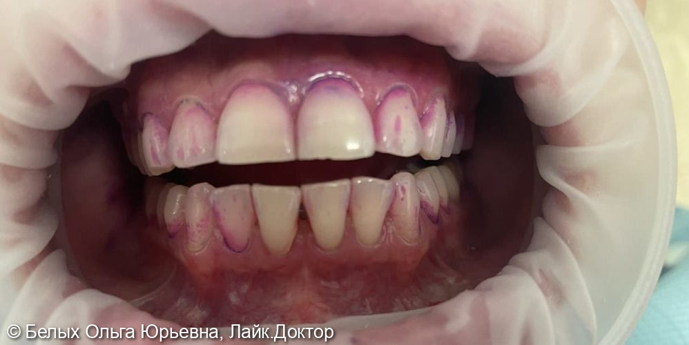Профессиональная гигиена зубов. Протокол GBT - фото №1