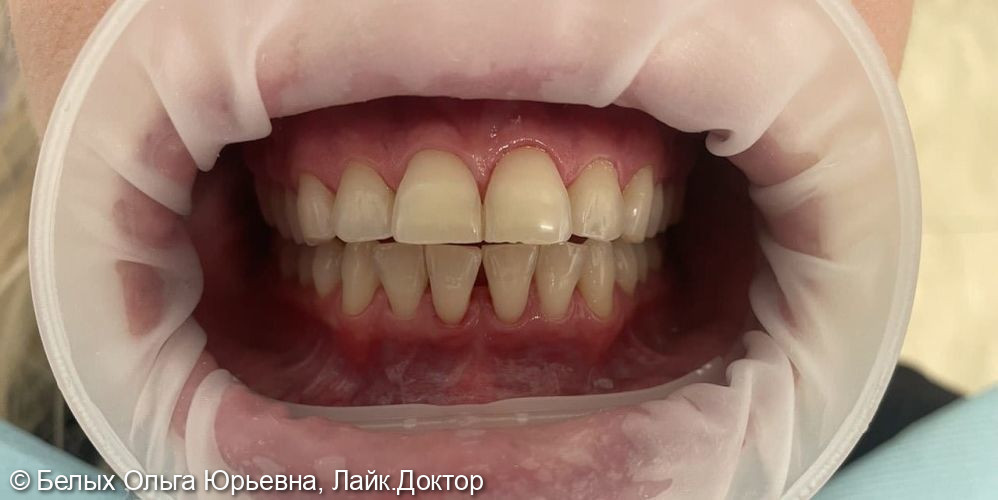 Профессиональная гигиена зубов. Протокол GBT - фото №2