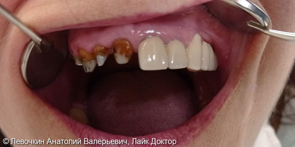 Замена металлокерамических коронок на зубах 11, 12, 13, 14 - фото №1