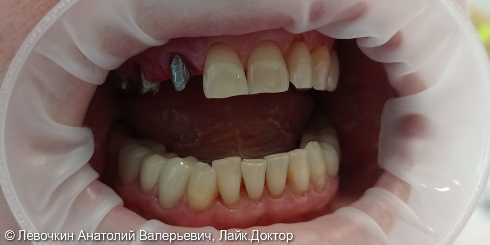 Замена мостовидного протеза с опорой на зубы 12, 14, 16 - фото №1