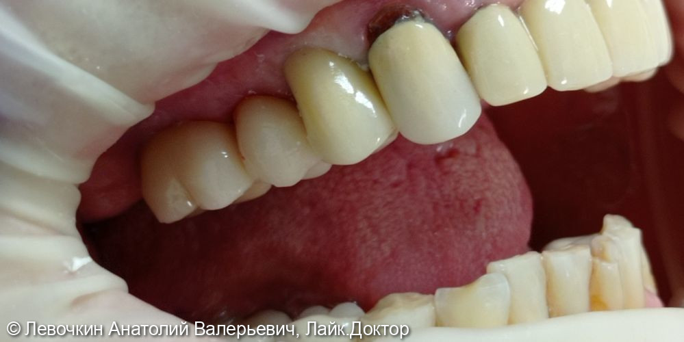 Восстановление коронковой части зуба коронкой из диоксида циркония - фото №1