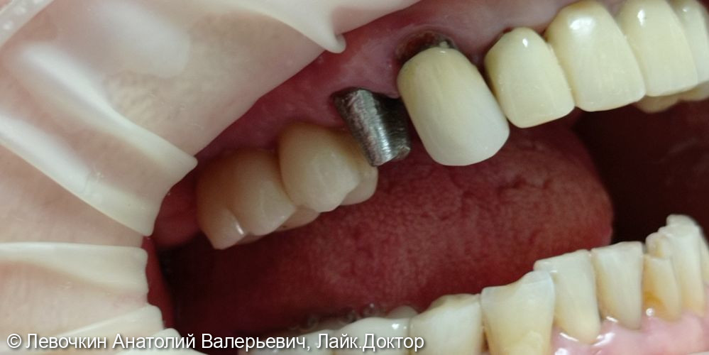 Восстановление коронковой части зуба коронкой из диоксида циркония - фото №3