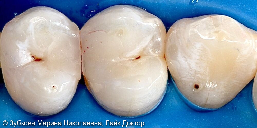 замена пломбировочного материала в зубе 24 - фото №1