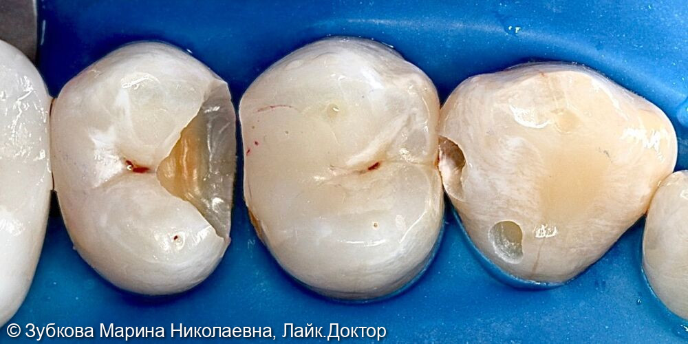 замена пломбировочного материала в зубе 24 - после