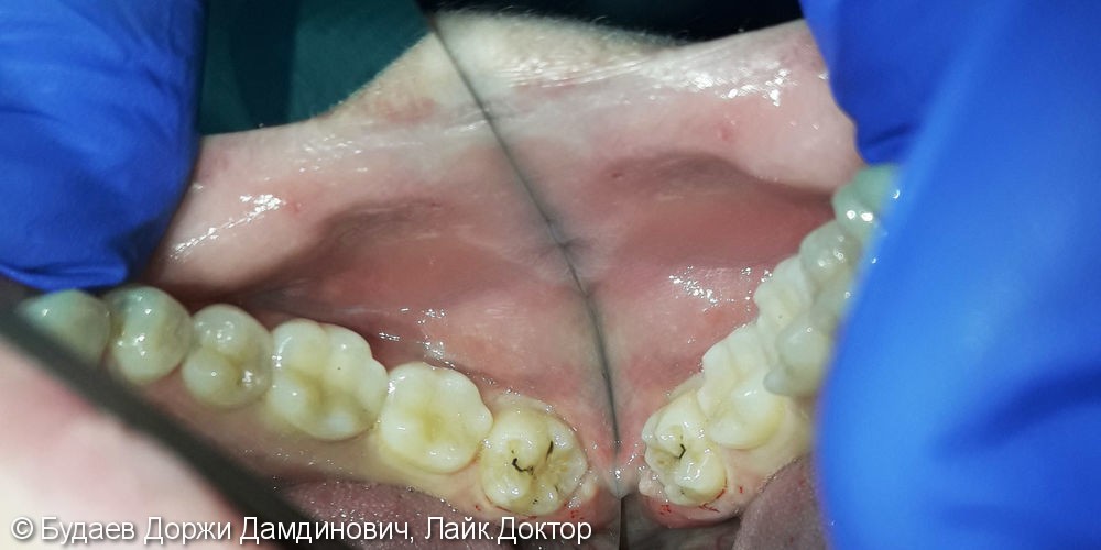 Реставрация зуба №38 с использованием фотополимера Ceram-X - фото №1