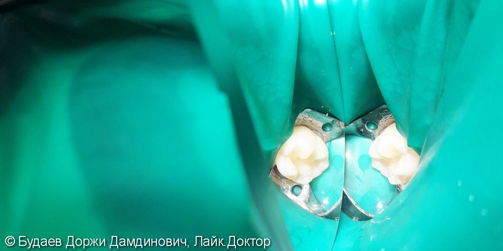 Реставрация зуба №38 с использованием фотополимера Ceram-X - фото №2
