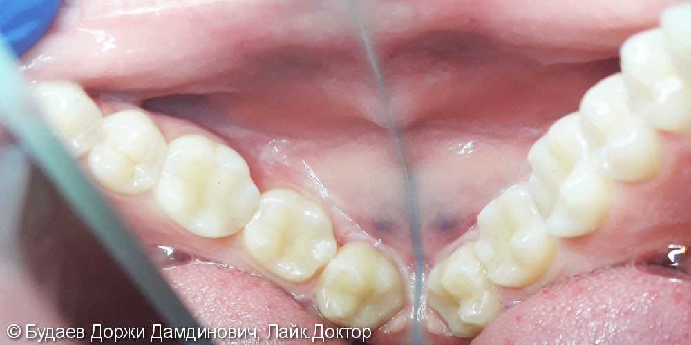 Реставрация зуба №38 с использованием фотополимера Ceram-X - фото №3