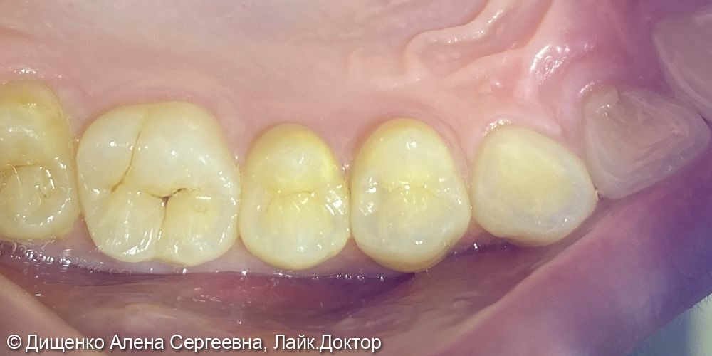 Кариес дентина 1.4, 1.5 зубов - фото №1
