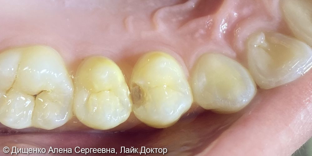 Кариес дентина 1.4, 1.5 зубов фото 2 · Якутск