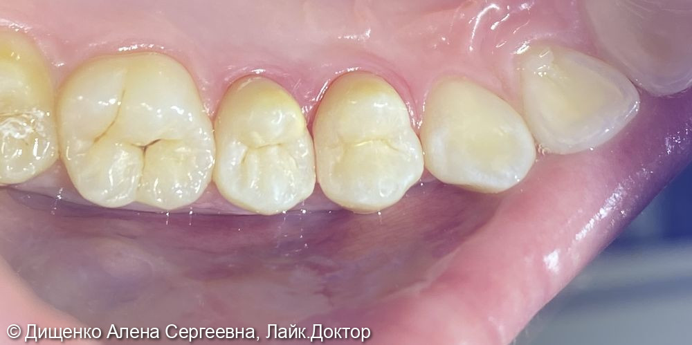 Кариес дентина 1.4, 1.5 зубов - фото №4