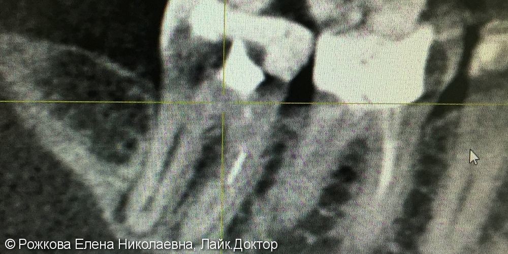 Лечение апикального периодонтита 4.7,извлечение фрагментов эндодонтических инструментов. - фото №2