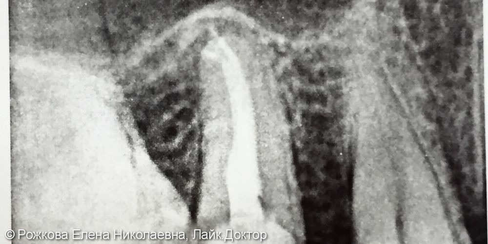 Эндодонтическое лечение под микроскопом 1.5. - фото №6