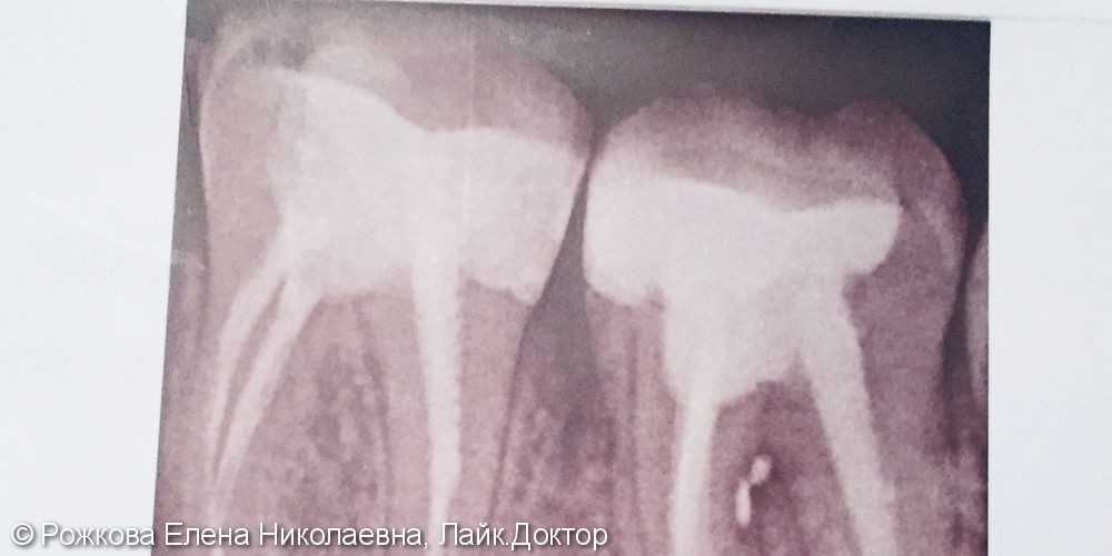 Кариес депульпированного зуба 3.6 - фото №2