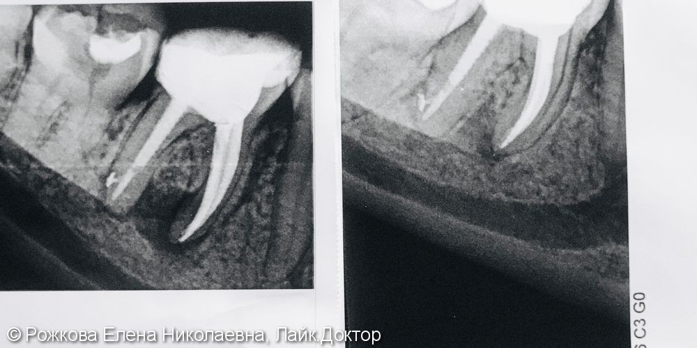 Лечение периодонтита 3.6 - фото №3