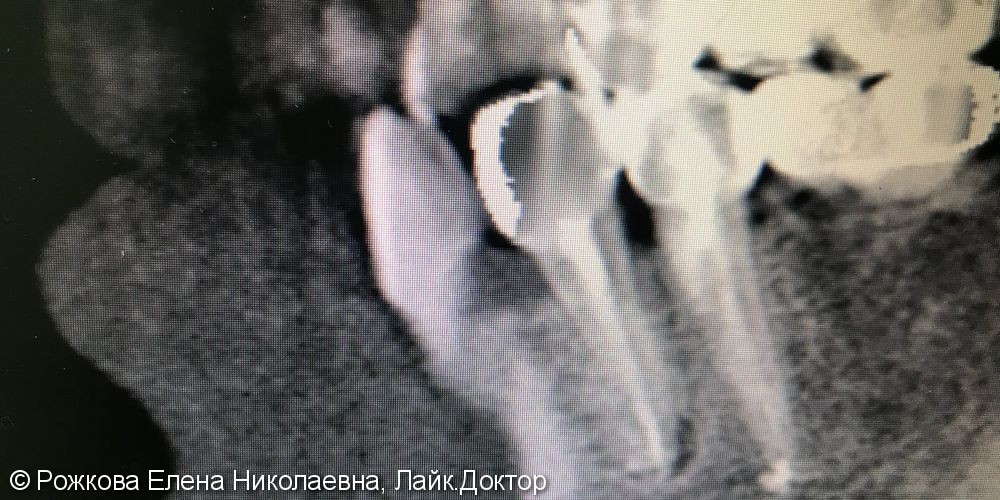 Перелечивание зуба 3.4 - фото №1