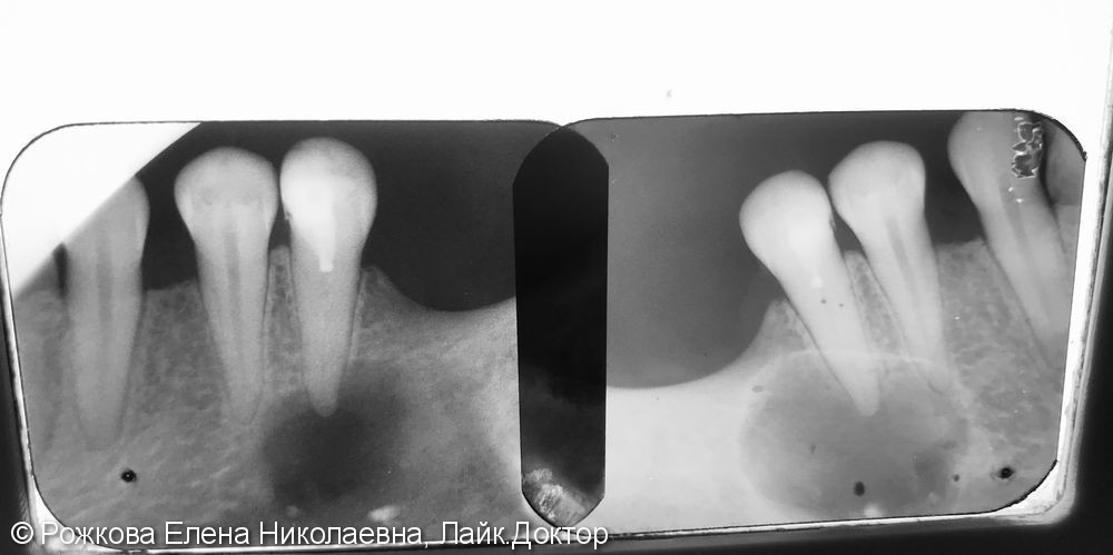 Перелечивание зуба 4.5 - фото №1