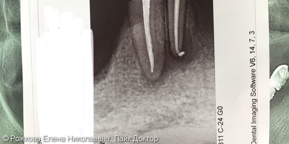 Перелечивание зубов 4.3,4.2 - фото №3