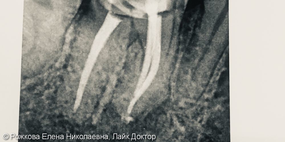 Лечение зуба 4.6 - фото №1