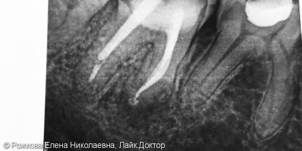 Лечение зуба 4.6 - фото №2