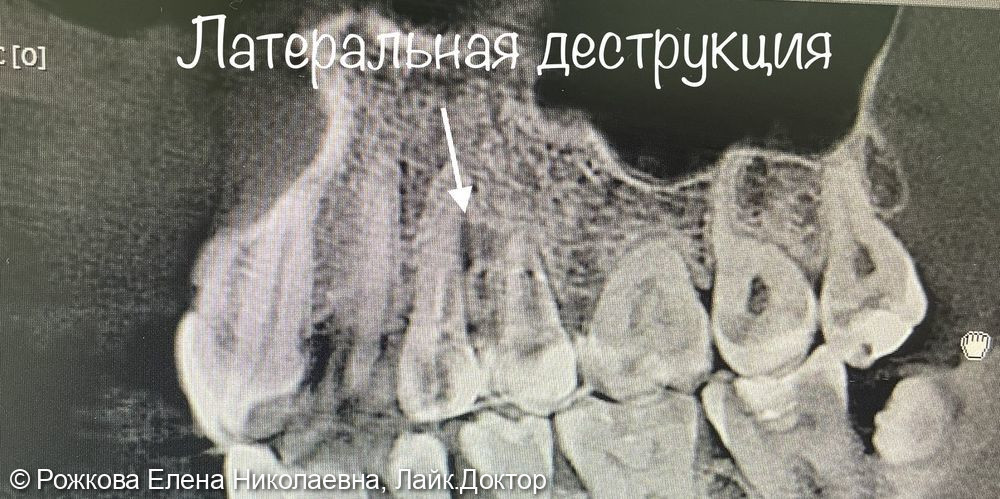 Лечение периодонтита фото 2 · Воронеж
